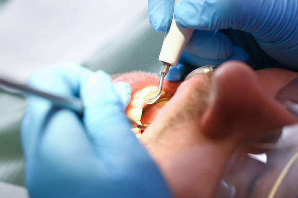 Best Emergency Root Canal Treatment in Hebron, MD